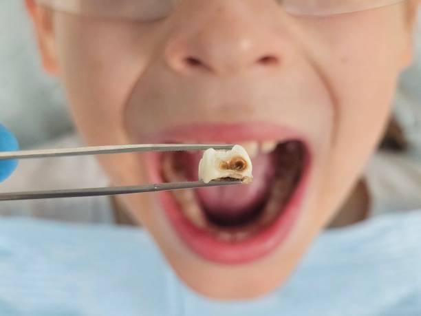 Best Emergency Broken Tooth Repair in Rouse, CA
